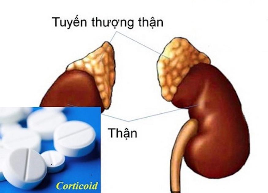 Suy thượng thận do thuốc Corticoid có thể chữa khỏi không?