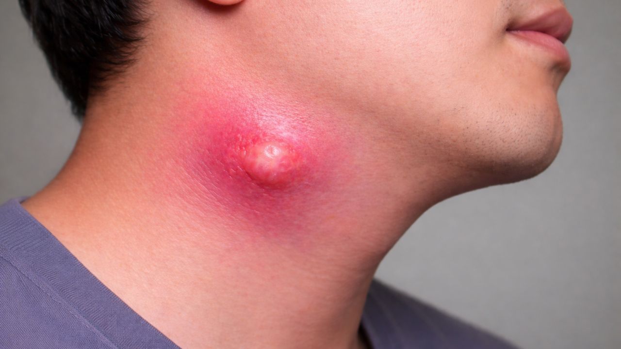&Aacute;p xe cổ - Bệnh nguy hiểm c&oacute; thể đe dọa t&iacute;nh mạng nếu ph&aacute;t ...