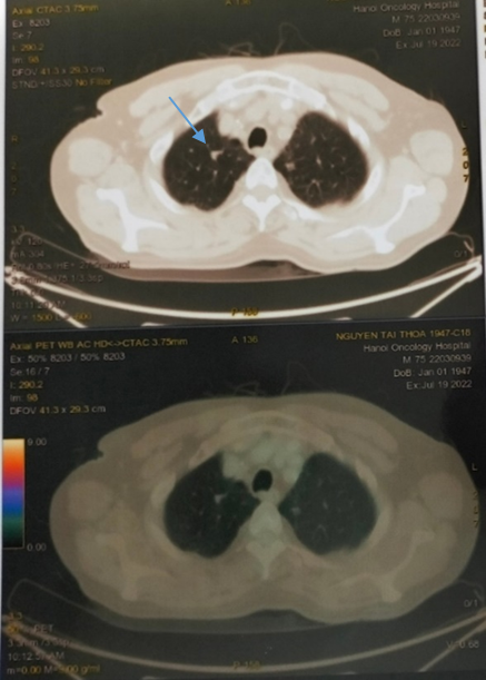 Vai trò của CT và PET/CT trong đánh giá đáp ứng điều trị và theo dõi ...