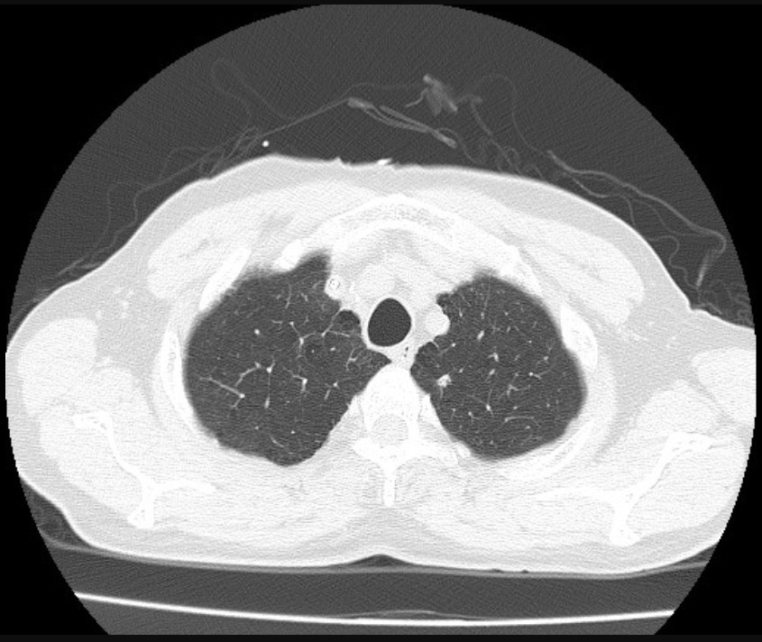 Vai trò của CT và PET/CT trong đánh giá đáp ứng điều trị và theo dõi ...