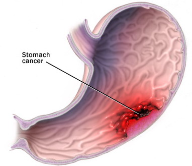 ungthu_da_day.jpg ungthu_da_day.jpg