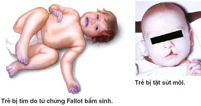 di-tat-bam-sinh-o-tre-so-sinh.jpg