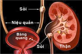 vi-sao-uong-nhieu-nuoc-giup-ngua-soi-than.jpg