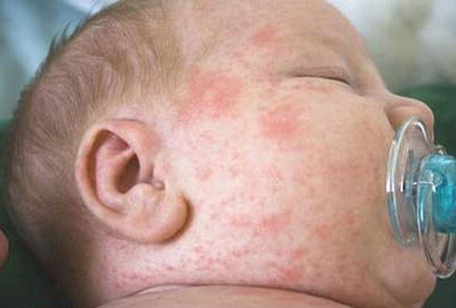 benh soi o tre so sinh phat ban esji