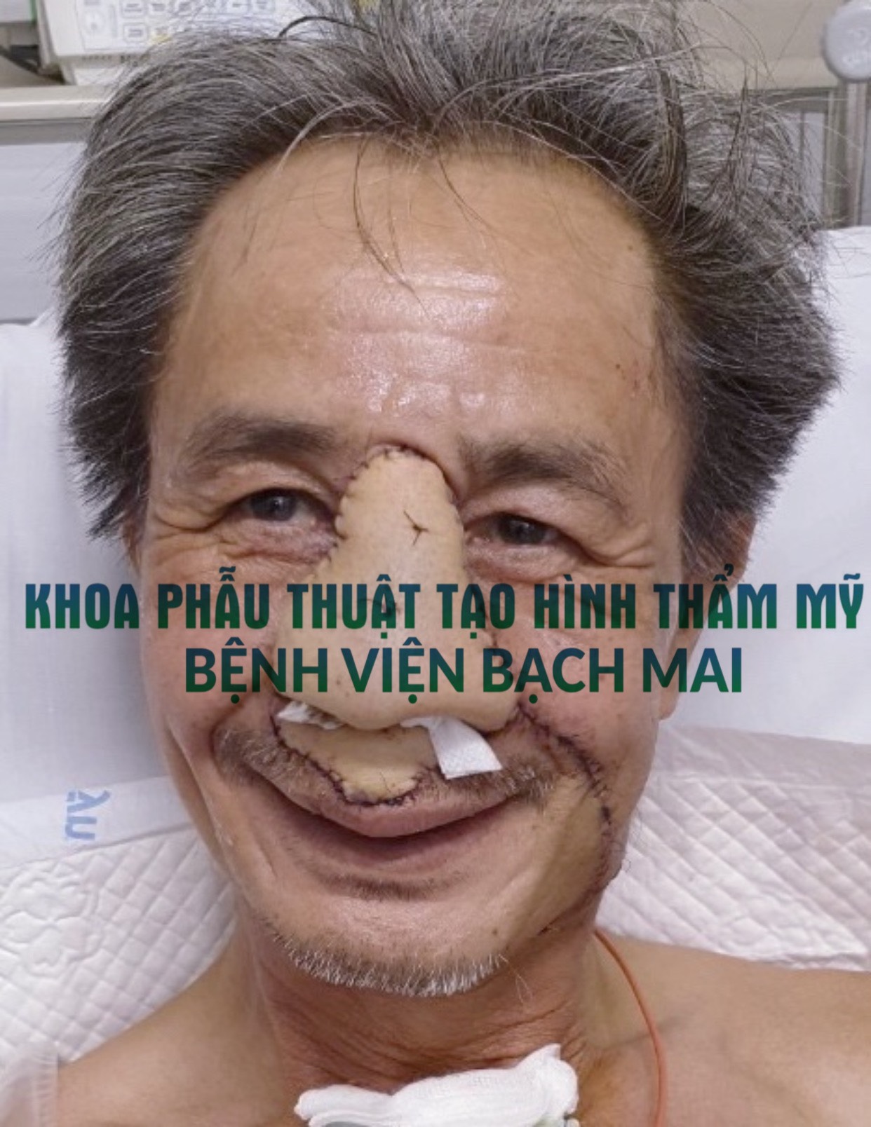 anh bn duoc tai tao mui