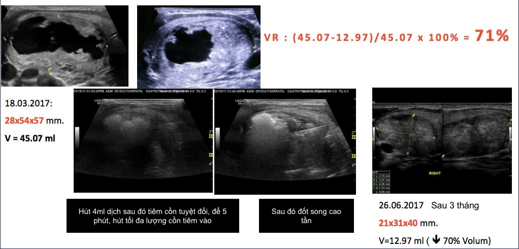 lanh tinh tuyen giap