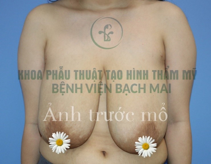 PHAU THUAT THU GON VU PHI DAI