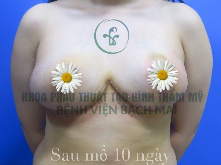 PHAU THUAT THU GON VU PHI DAI2