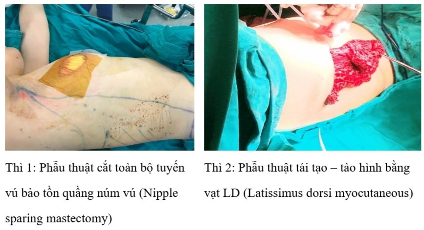 21.2.2022 h.a 2 thi phau thuat