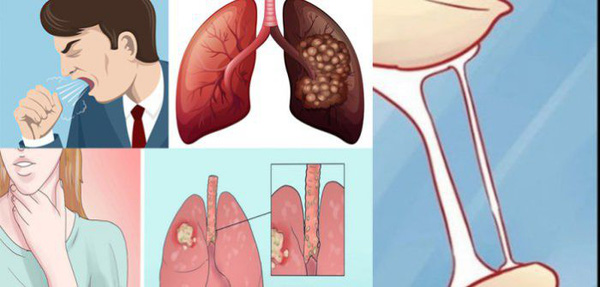 cancer pulmonar 700x335 15329688352581807780227