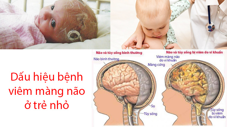 anh bai 1. Dau hieu vime mang nao o tre nho