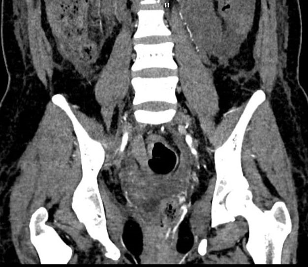 lan dau viet nam can thiep ca ton thuong dong mach truc trang