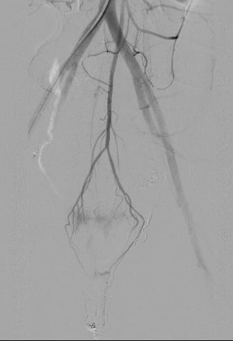 lan dau viet nam can thiep ca ton thuong dong mach truc trang3