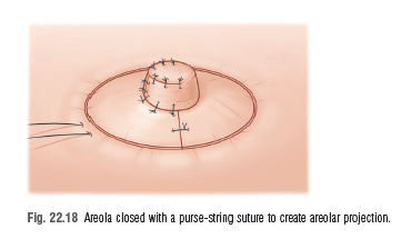 tao hinh num vu tren vu tai tao2012