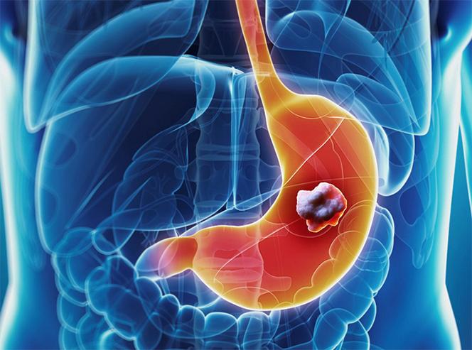 ttin thuong thuc ung thu da day