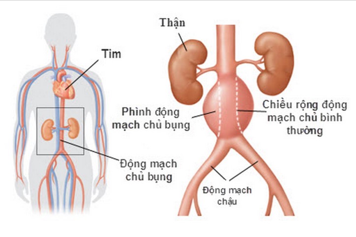 phinh dong mach
