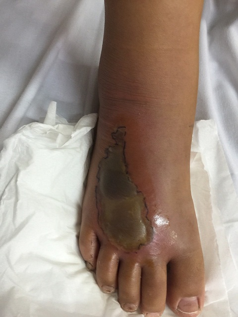 hinh anh ban chan bi ran can cua chau H 12t