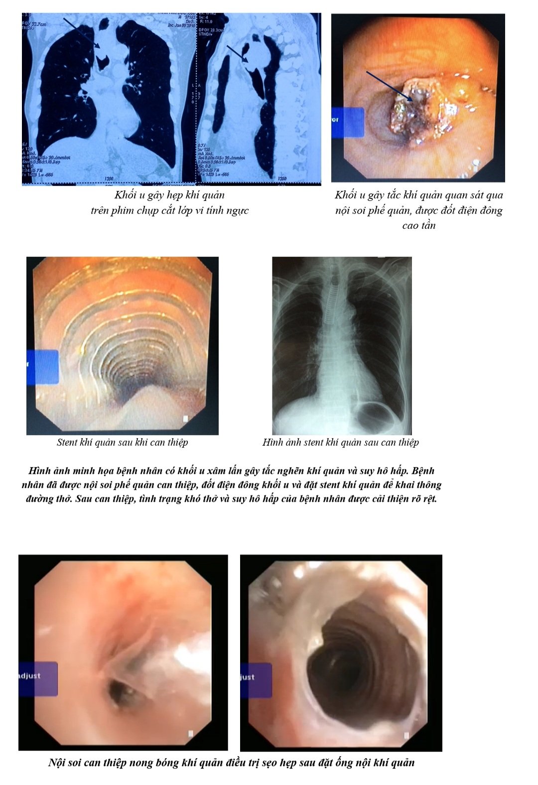 1.3.2022 hinh noi soi can thiep tac nghen duogn tho trung tam