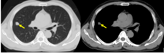 vai tro cua chup CLVT 1