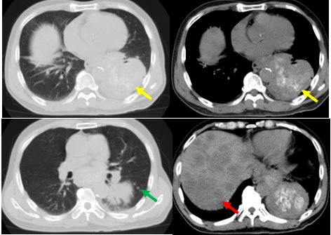 vai tro cua chup CLVT 2