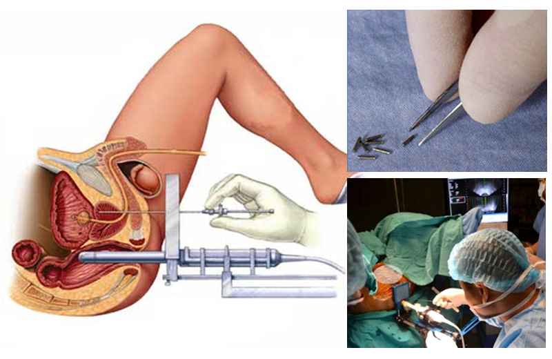 quy trinh cay hat phong xa dieu tri ung thu tuyen tien liet1576067627