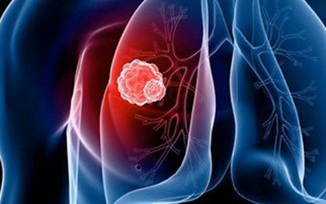 ung thu 15410692098151587591336 crop 15410692421741835595196