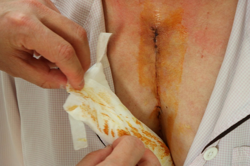 h.a vet mo bn u trung that khong lo