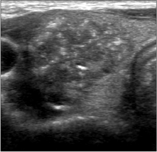 h2. hinh anh sieu am tuyen giap