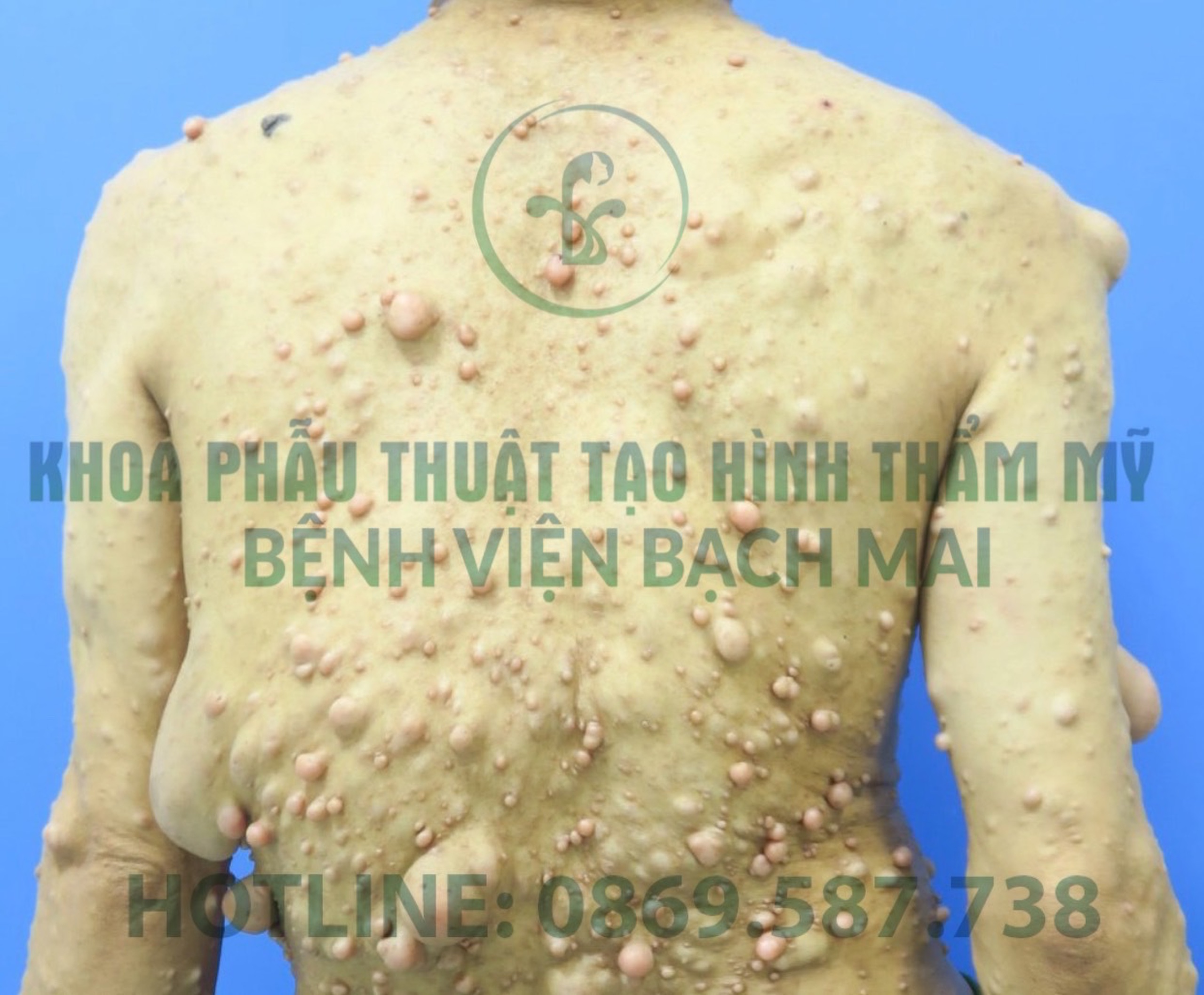 U soi than kinh ngoai vi