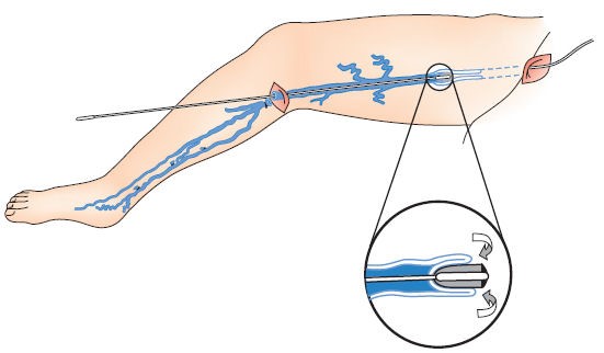 gian tinh mach chi duoi