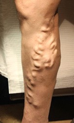 gian tinh mach chi duoi1