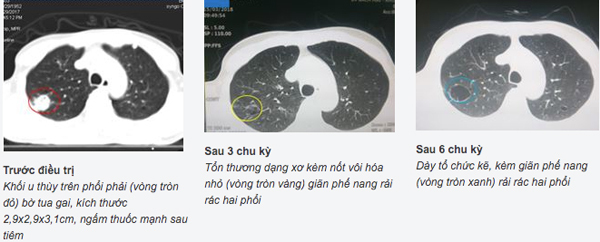 nghien sat thu so 1 nguoi dan ong phat hien ung thu phoi giai doan cuoi