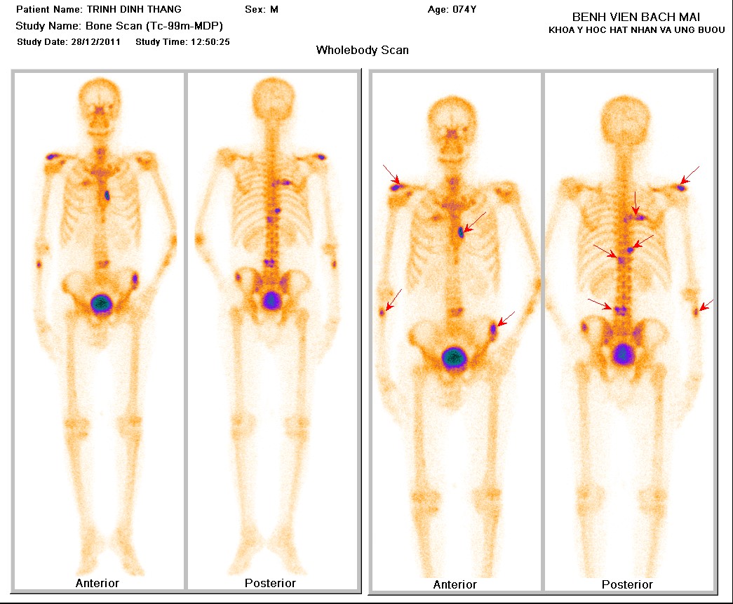 bai2 ttin thuong thuc ung thu da day4