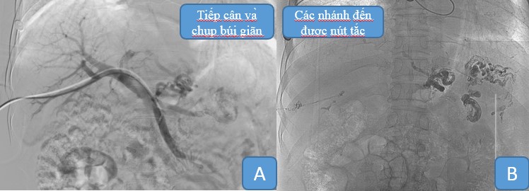 nut mach xuat huyet 4