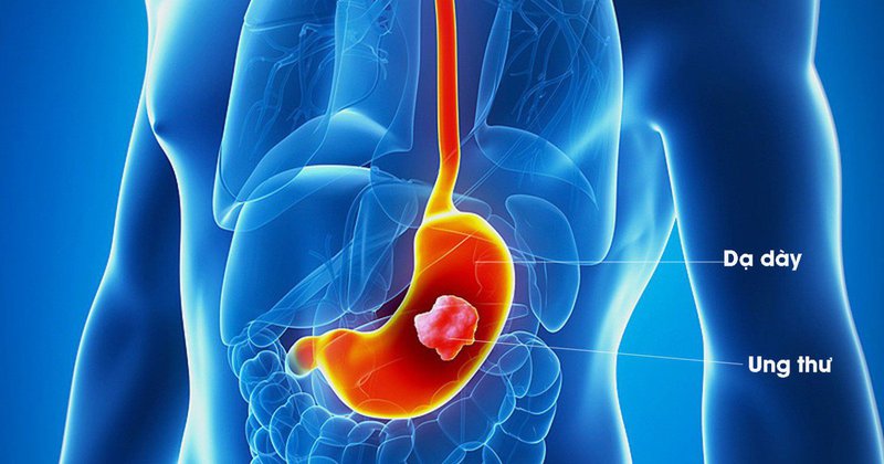 ung thu da day la benh co the chua khoi neu phat hien som