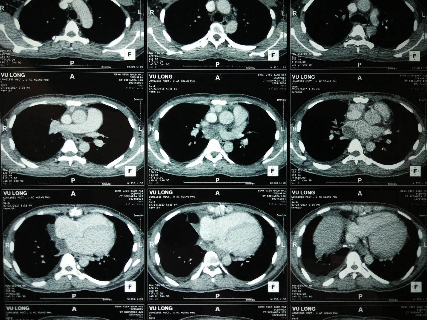 ung thu bao hoat dich