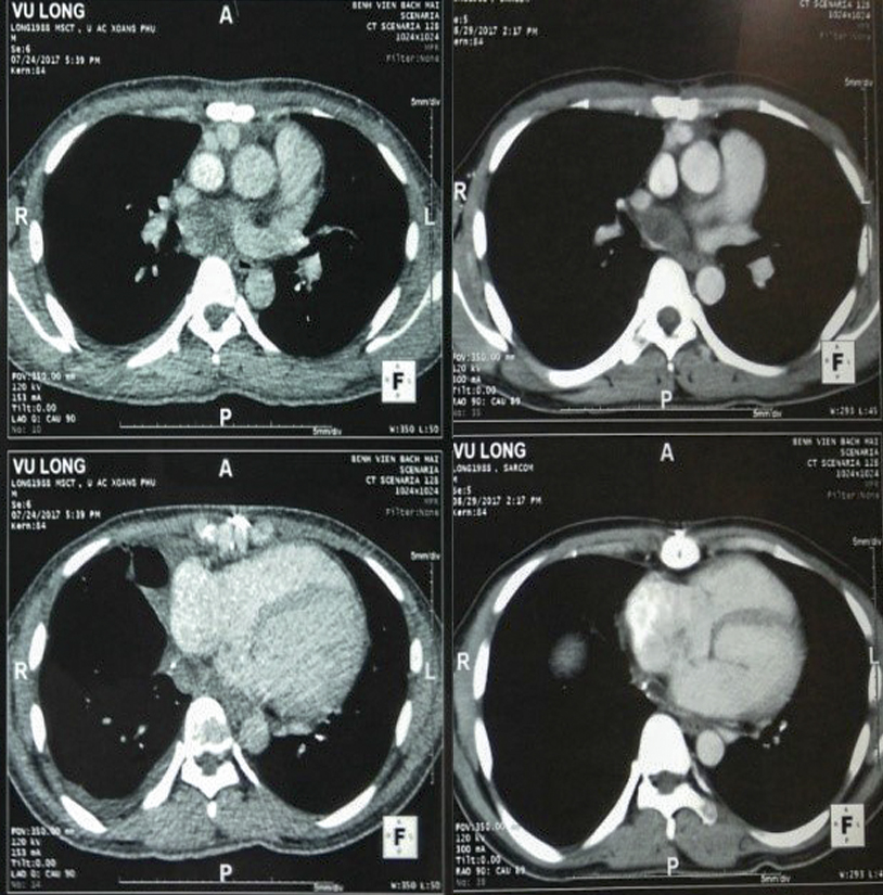ung thu bao hoat dich3