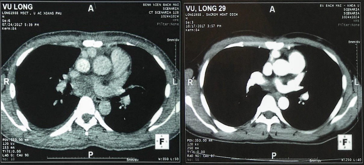 ung thu bao hoat dich4