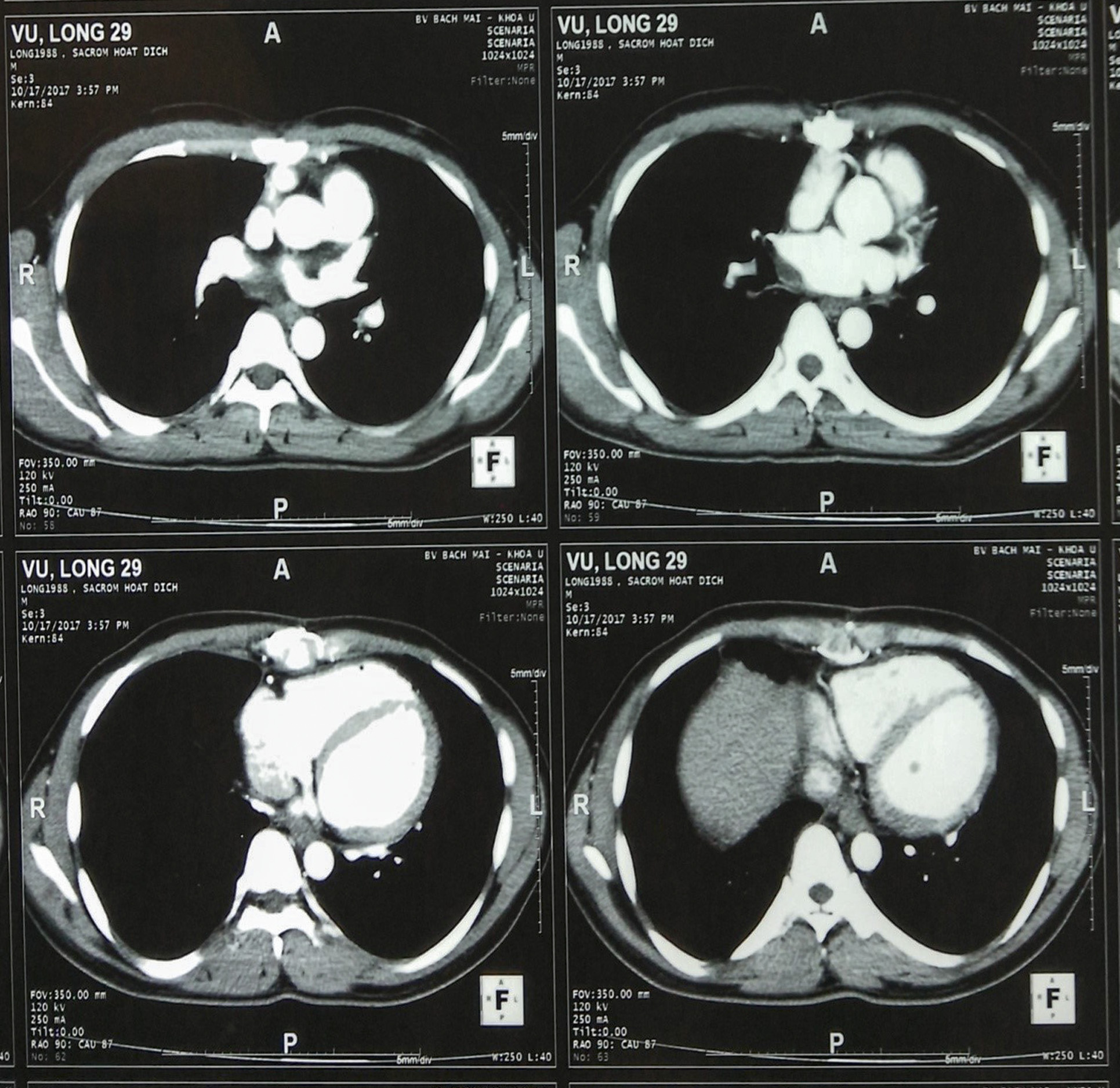 ung thu bao hoat dich6