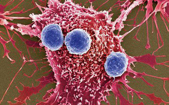 ung thu 15453915214981058835960 crop 15453915282501768398997