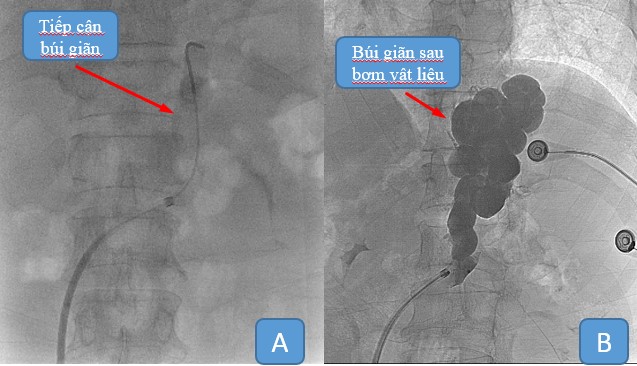 nut mach xuat huyet 001 3