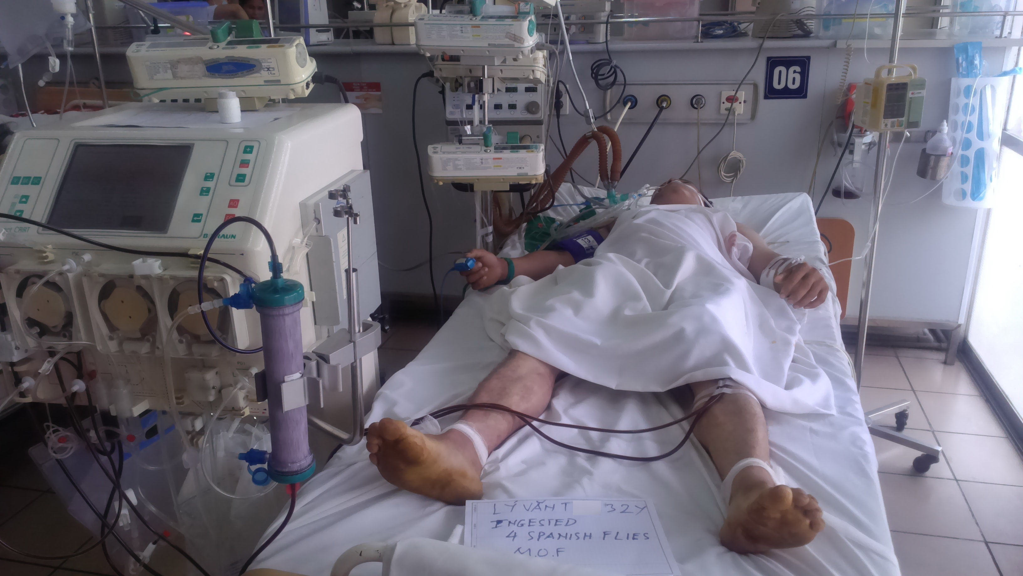 mot BN ngo doc sau ban mieu dieu tri tai TTCD