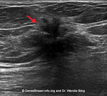 5 chan doan som ung thu vu 22032022