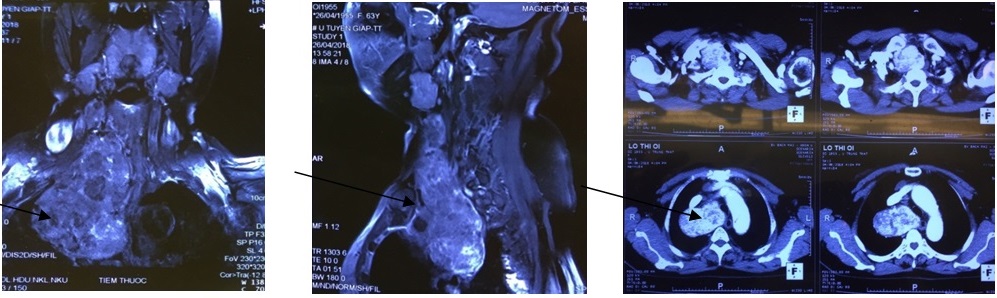 ha CLVT va CHT khoi u