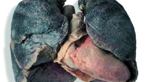 1ung thu phoi 1245 NSVA