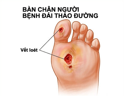 loetchanonguoitieuduong